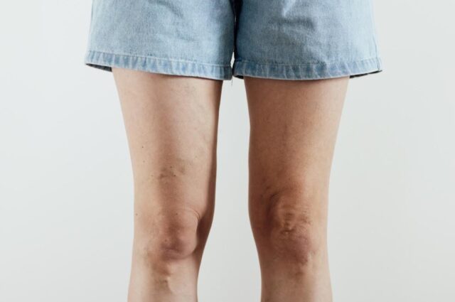 VARICES03.jpg